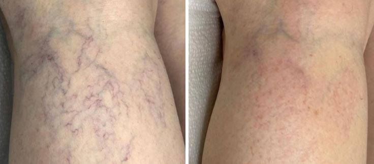 Before and after comparison of leg skin showing a reduction in spider veins after treatment.