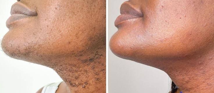 Before and after comparison of chin and neck area showing a reduction in dark hair growth and skin texture improvement.