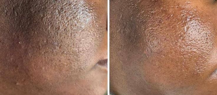 Before and after comparison of skin showing a reduction in texture and surface irregularities after a dermatological treatment.
