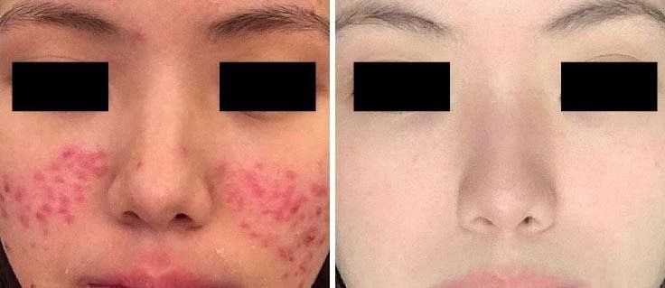 Before and after comparison of a person's face, showing improvement in red skin rashes on cheeks after treatment.
