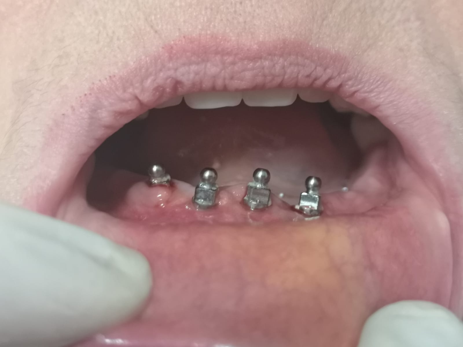 Impianto dentale eseguito dalla Dottoressa Lombardi
