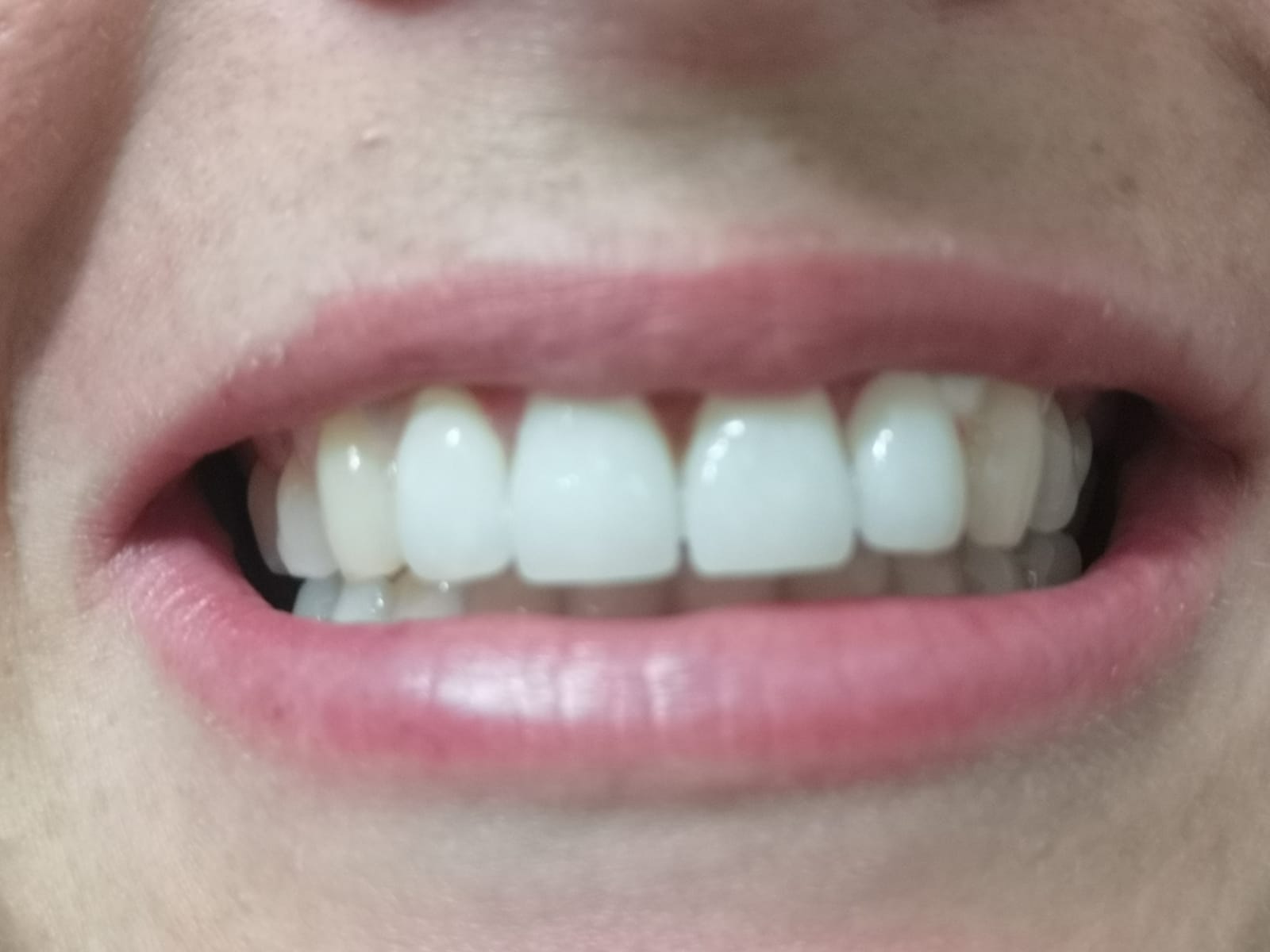 Primo piano della bocca di una persona, che mostra i denti bianchi e le labbra rosa.