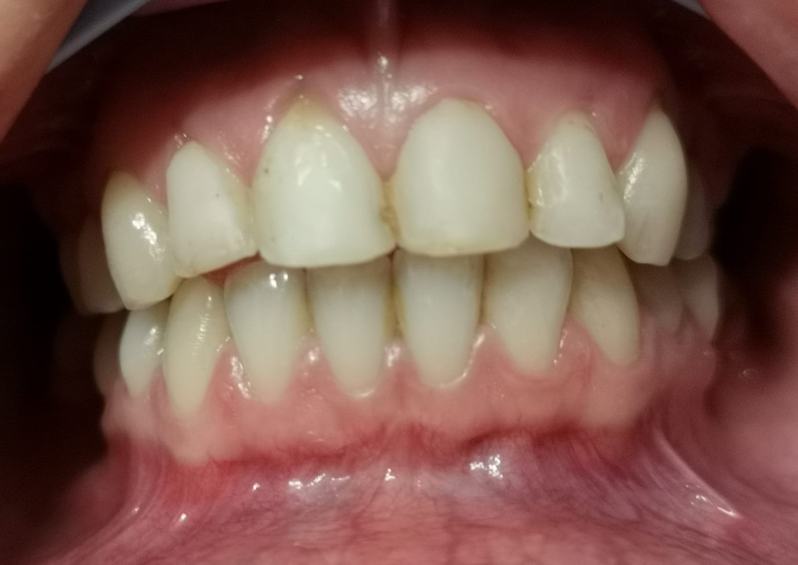 Primo piano di una bocca con una dentatura completa di colori bianchi, gengive rosa e denti superiori leggermente ingialliti.