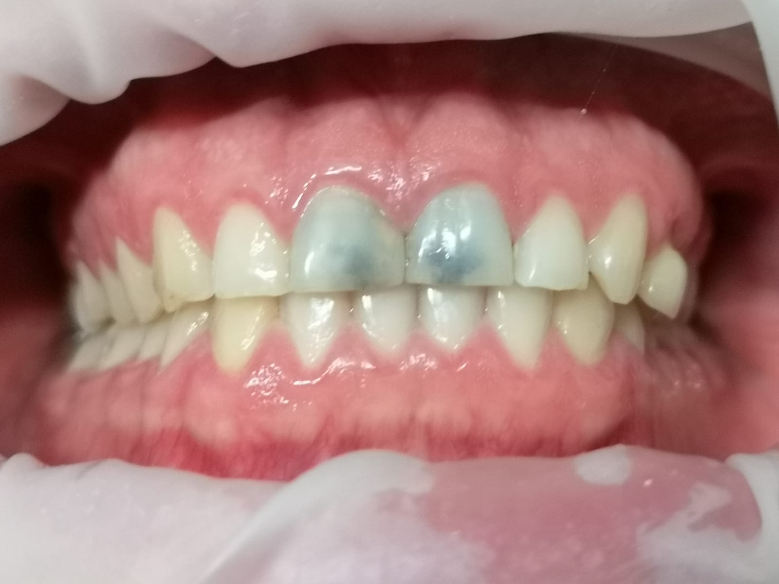 Primo piano della bocca; due denti anteriori appaiono di colore blu scuro/grigio in contrasto con gli altri denti bianchi.