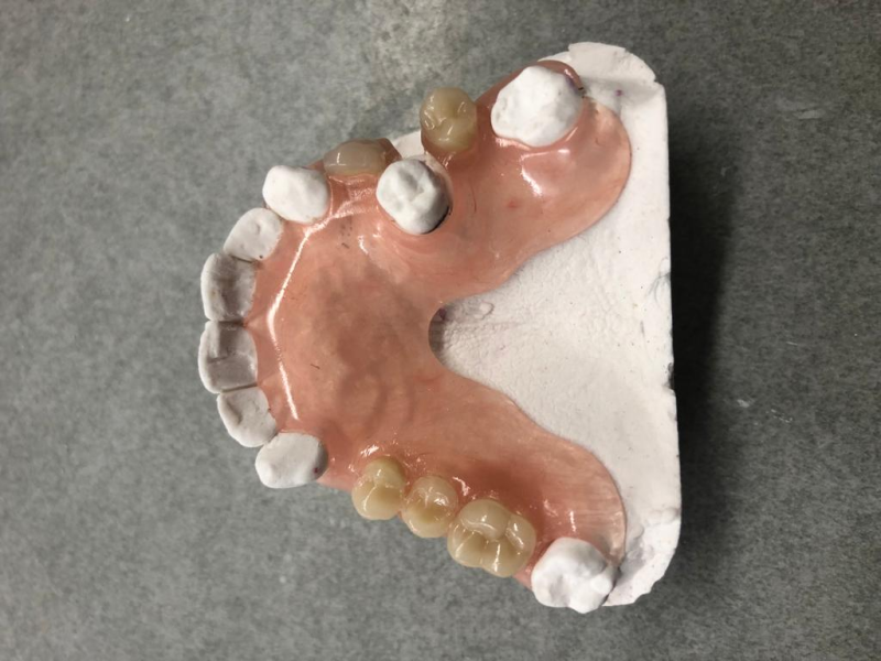 protesi in ceramica