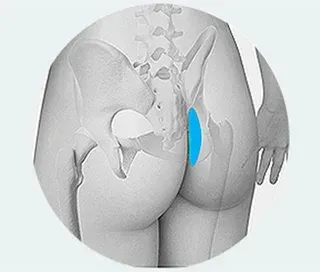 코성형 재료 자가진피