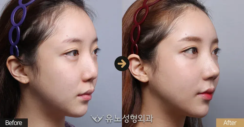 코재수술 · 휜코교정 · 매부리교정 전후사진 45도 - 유노성형외과