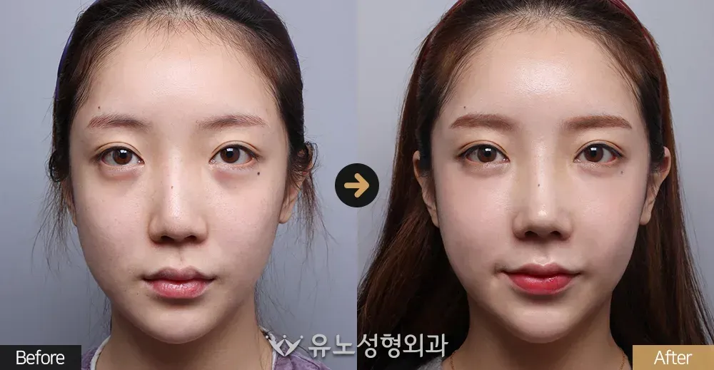 코재수술 · 휜코교정 · 매부리교정 전후사진 정면 - 유노성형외과