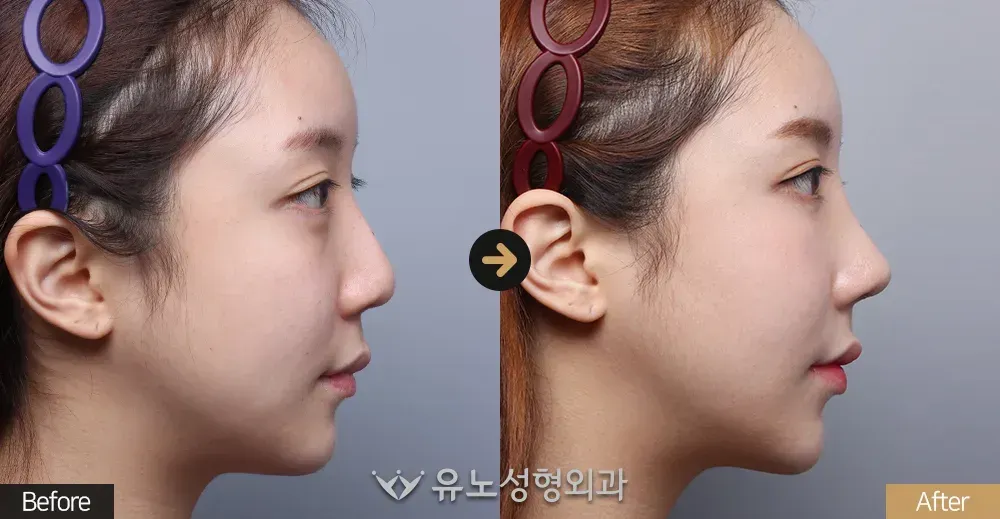 코재수술 · 휜코교정 · 매부리교정 전후사진 측면 - 유노성형외과