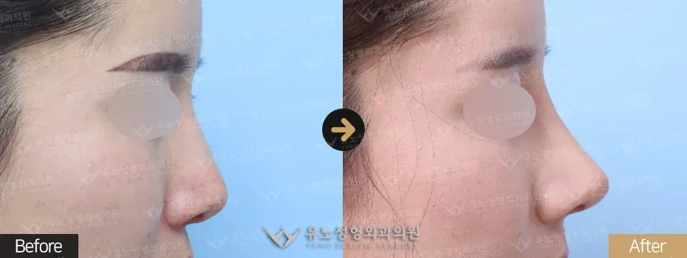 코재수술 · 복코교정 전후사진 정면 - 유노성형외과