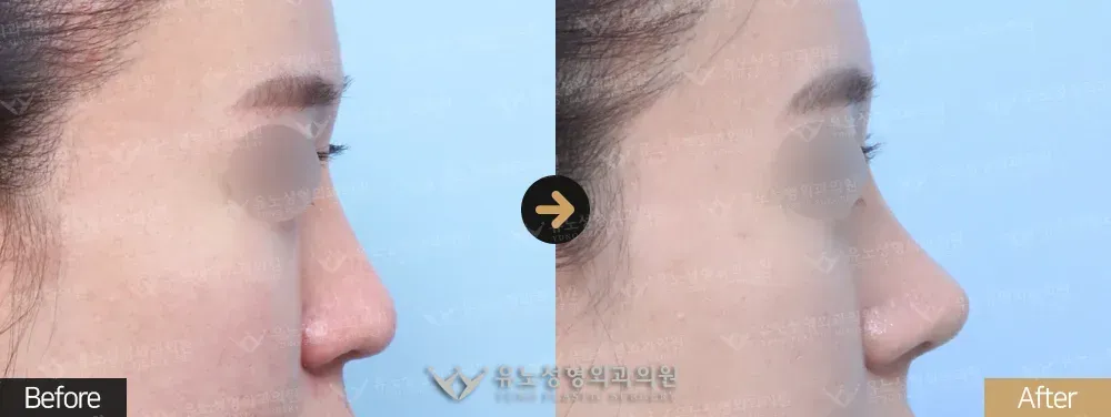 코재수술 · 복코 · 긴코교정 전후사진 정면 - 유노성형외과