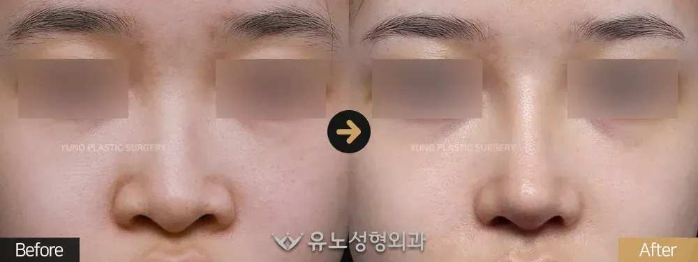 콧볼축소 · 입매교정 전후사진 정면 - 유노성형외과