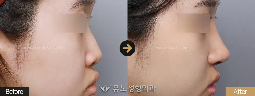 콧볼축소 · 입매교정 전후사진 측면 - 유노성형외과