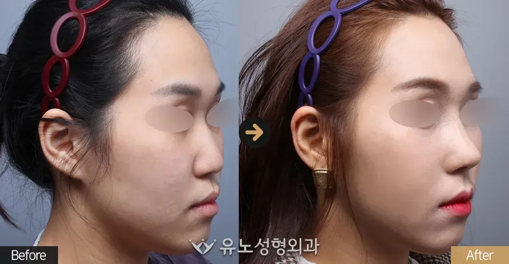 매부리교정 전후사진 45도 - 유노성형외과