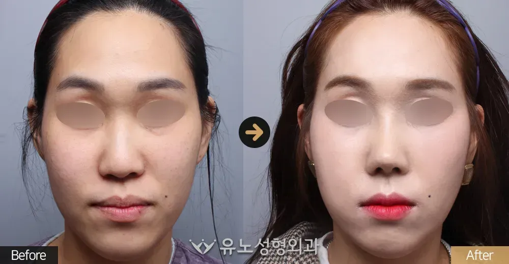 매부리교정 전후사진 정면 - 유노성형외과