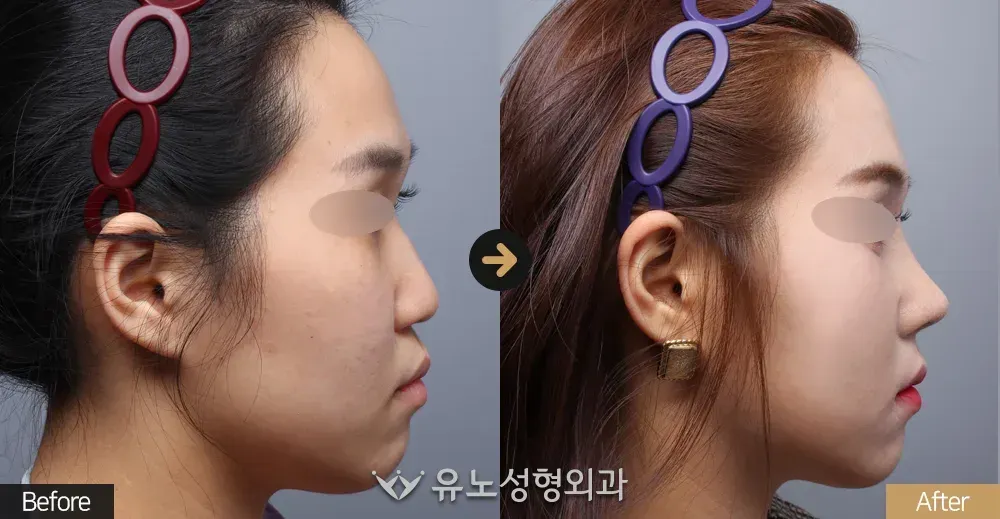 매부리교정 전후사진 측면 - 유노성형외과