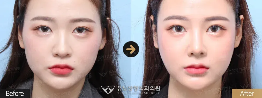 코성형 · 매부리교정 · 복코 전후사진 정면 - 유노성형외과