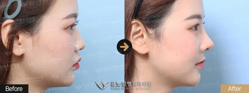 코성형 · 매부리교정 · 복코 전후사진 측면 - 유노성형외과