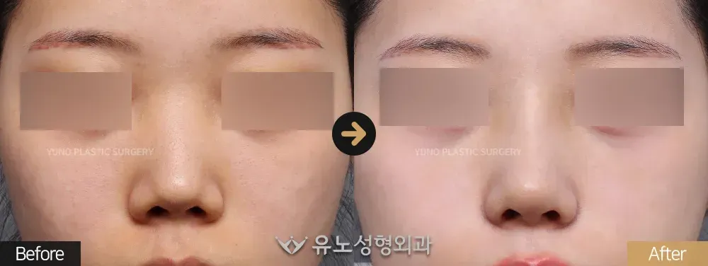 짧은코교정 · 비주교정 전후사진 정면 - 유노성형외과