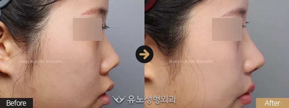 짧은코교정 · 비주교정 전후사진 측면 - 유노성형외과