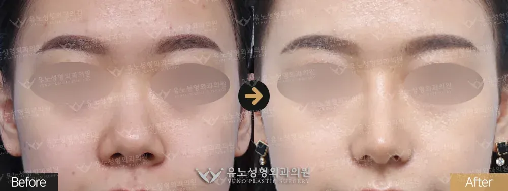 복코교정 · 콧볼축소 전후사진 정면 - 유노성형외과