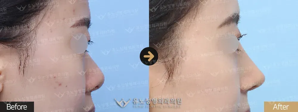 복코교정 · 콧볼축소 전후사진 측면 - 유노성형외과