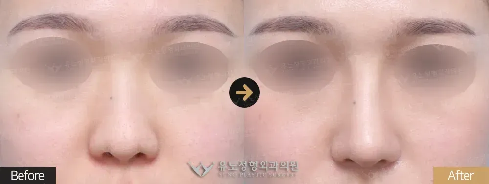 낮은코성형 · 복코교정 전후사진 정면 - 유노성형외과