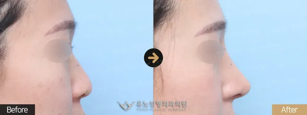 낮은코성형 · 복코교정 전후사진 측면 - 유노성형외과