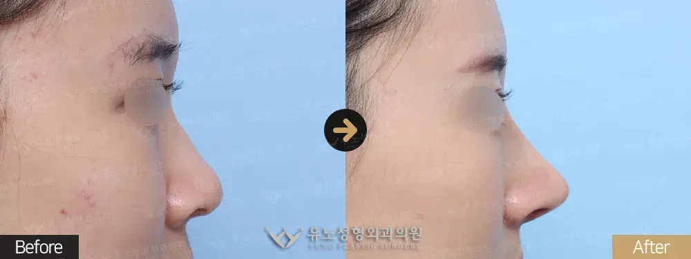 복코교정 · 콧볼축소 전후사진 측면 - 유노성형외과