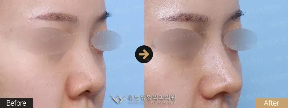 복코교정 · 콧볼축소 · 비주교정 전후사진 45도 - 유노성형외과