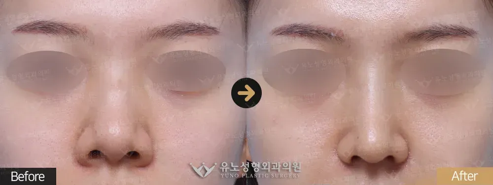 복코교정 · 콧볼축소 · 비주교정 전후사진 정면 - 유노성형외과