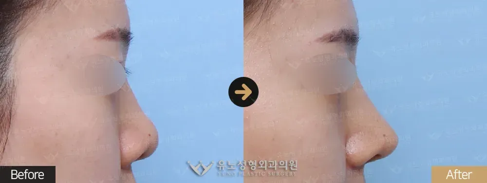 복코교정 · 콧볼축소 · 비주교정 전후사진 측면 - 유노성형외과