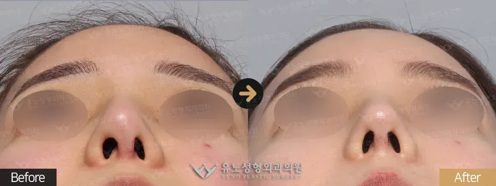 코재수술 · 콧구멍 비대칭 개선 · 휜코교정 전후사진 45도 - 유노성형외과