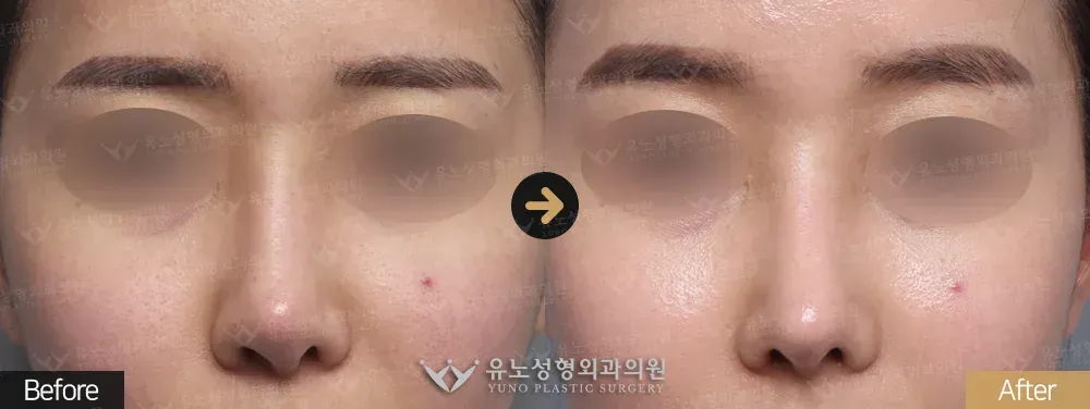 코재수술 · 콧구멍 비대칭 개선 · 휜코교정 전후사진 정면 - 유노성형외과