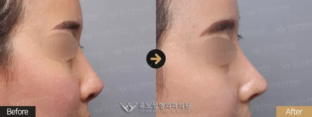 코재수술 · 콧구멍 비대칭 개선 · 휜코교정 전후사진 측면 - 유노성형외과