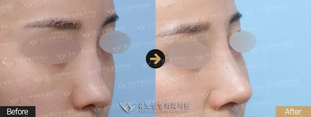 낮은코성형 전후사진 정면 - 유노성형외과