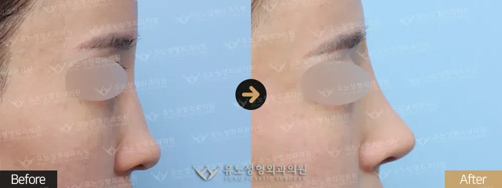 낮은코성형 전후사진 측면 - 유노성형외과