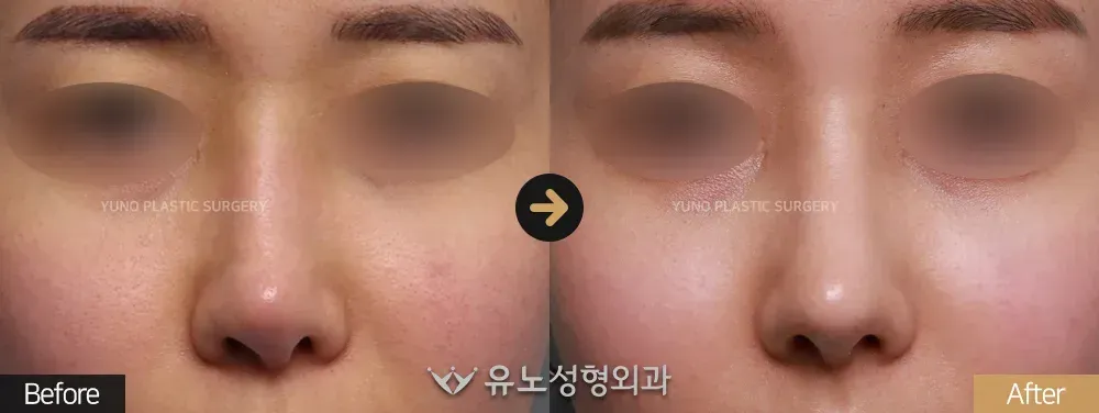 코재수술 · 휜코 · 짧은코교정 전후사진 정면 - 유노성형외과