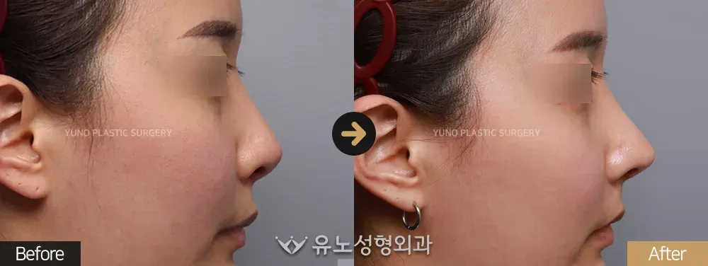 코재수술 · 휜코 · 짧은코교정 전후사진 측면 - 유노성형외과