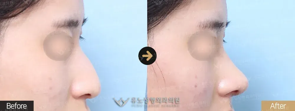 융비술 · 절골 · 긴코교정 · 코끝수술 전후사진 측면 - 유노성형외과