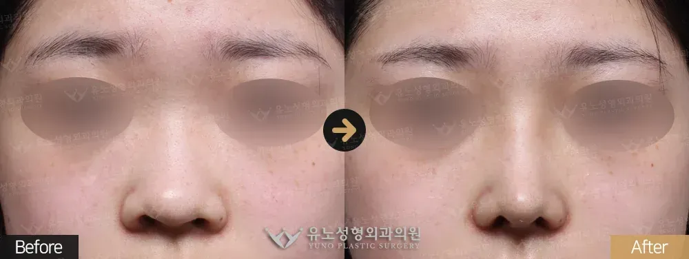 복코교정 · 콧볼축소 전후사진 정면 - 유노성형외과
