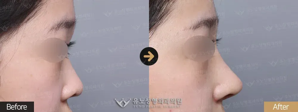 복코교정 · 콧볼축소 전후사진 측면 - 유노성형외과
