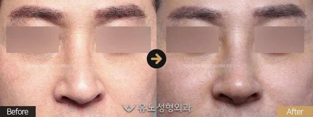 남자 코성형 · 코재수술 · 휜코교정 전후사진 정면 - 유노성형외과