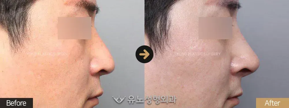 남자 코성형 · 코재수술 · 휜코교정 전후사진 측면 - 유노성형외과