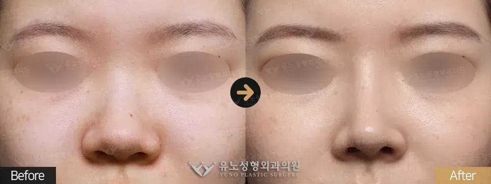 코성형 · 복코 전후사진 45도 - 유노성형외과