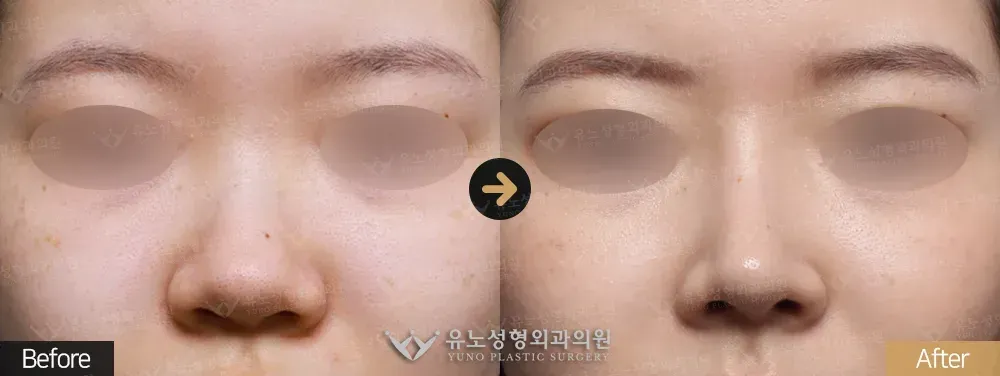 코성형 · 복코 전후사진 정면 - 유노성형외과