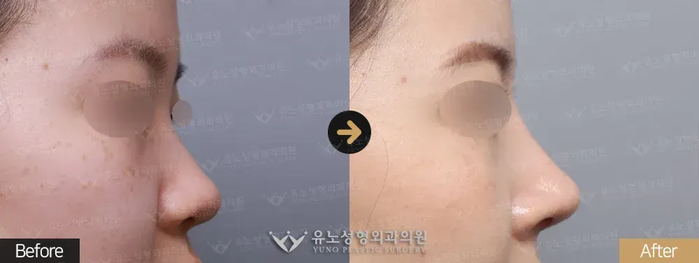 코성형 · 복코 전후사진 측면 - 유노성형외과