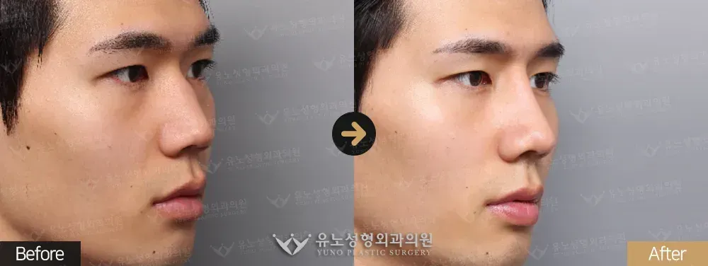 남자 코성형 · 매부리교정 · 절골 · 비공내리기 전후사진 45도 - 유노성형외과