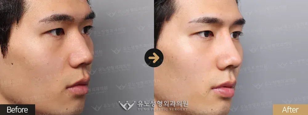 남자 코성형 · 매부리교정 · 절골 · 비공내리기 전후사진 정면 - 유노성형외과