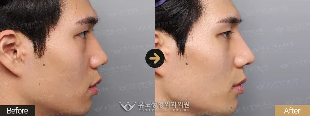 남자 코성형 · 매부리교정 · 절골 · 비공내리기 전후사진 측면 - 유노성형외과